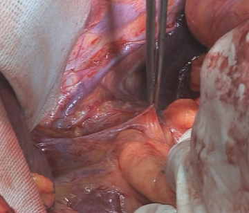Mobilizing the intraabdominal esophagus