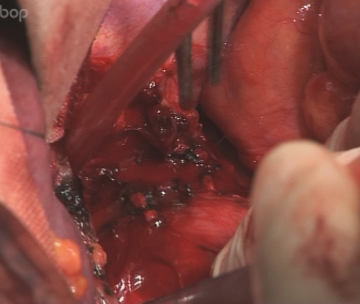 Opening the esophageal hiatus and dissecting the distal esophagus