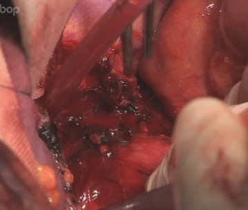 Opening the esophageal hiatus and dissecting the distal esophagus