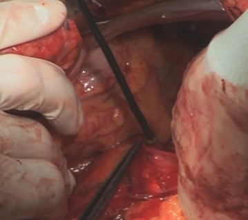 Freeing the duodenum