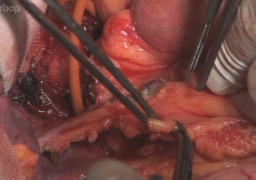 Abdominal lymphadenectomy