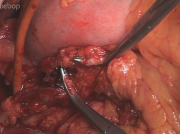 Dividing V. gastrica dextra/sinistra and left gastric artery