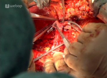 Extirpación del hígado del receptor