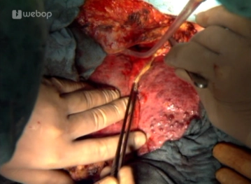 Movilización del hígado