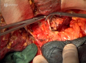 Sección de las arterias hepáticas