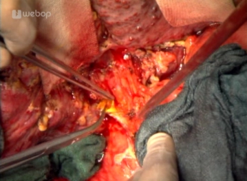 Transección del conducto biliar