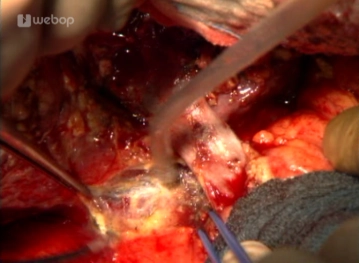 Movilización del lóbulo hepático derecho