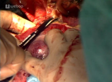 Sección de las venas hepáticas