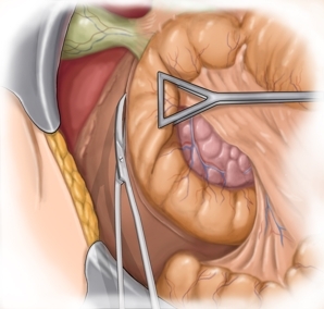 Incising the periduodenal peritoneum