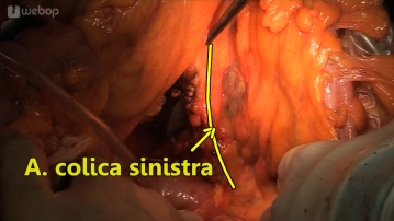 Dissection of the left colic artery