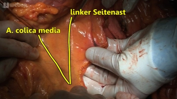 Transection of the mesocolon