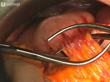 Dividing the greater omentum off the stomach