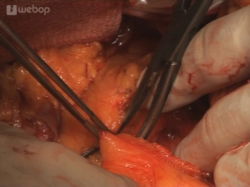 Dividing the left colic vein