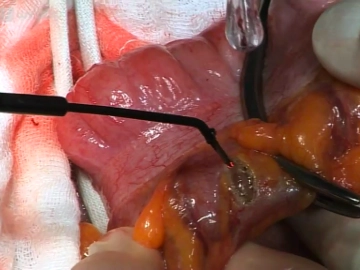 Transection of the intestine