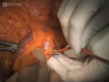 Determining the proximal resection margin