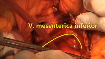 Transection of the left colic vein 1