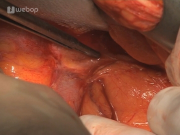 Mobilizing the descending colon and sigmoid