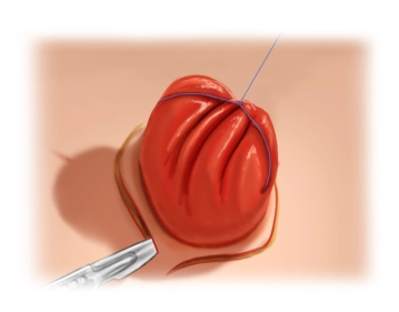 Skin Incision