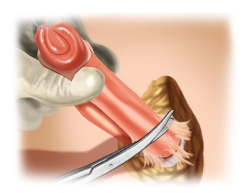 Mobilization and Preparation on the Fascia