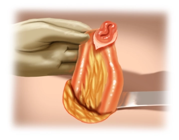 Mobilization of Small Intestine