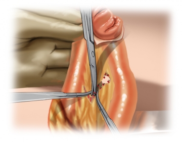 Dissecting the mesentery