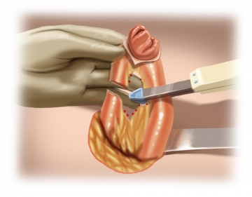 Stoma resection