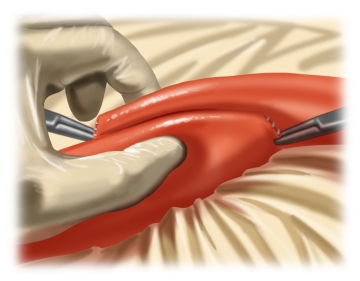 Preparing the anastomosis