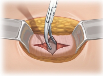 Splitting the muscles