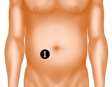 Stoma site marking