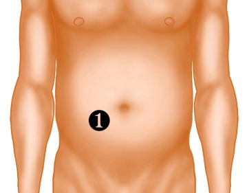 Stoma Marking