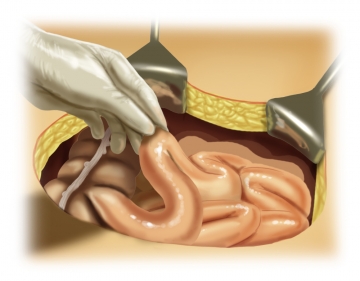 Locating the loop of the terminal ileum