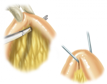 Taping the ileum loop