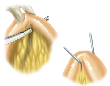 Suspension of the Ileal Loop