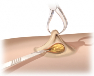 Skin incision for stoma and dissection down to the fascia.