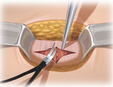 Dividing the anterior lamina of the rectus sheath