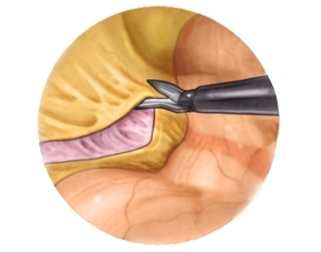 Mobilizing the bowel segmented selected for stoma construction