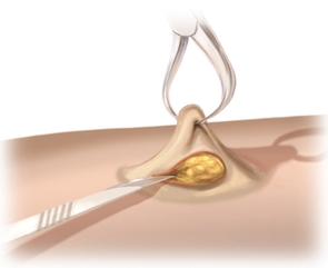 Skin incision for stoma and dissection down to the fascia.