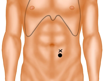 Positioning of the stoma