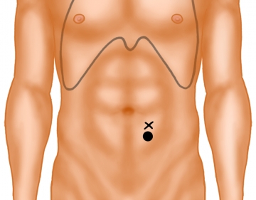 Stoma site marking