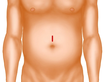 Skin Incision and Preparation on the Fascia