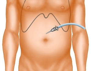 Establishing the pneumoperitoneum and inserting the optical trocar and camera