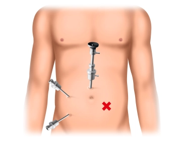 Insertion of the Working Trocars