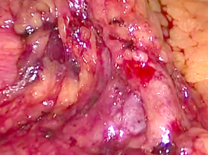 Dissecting the ileocolic vessels