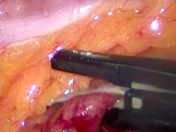 Transection of the Ileocolic Artery and Vein