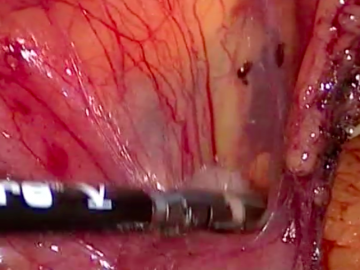 Dividing mesocolon and mesentery