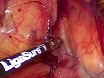 Mobilization of the Terminal Ileum