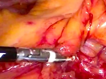 Transection of the Mesentery