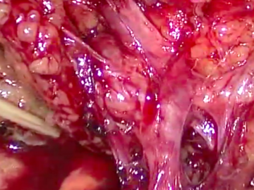 Dividing the right colic artery