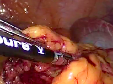 Dividing the transverse mesocolon