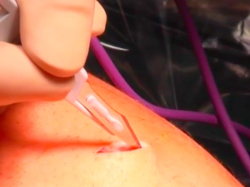 Skin incision and Verres needle insertion